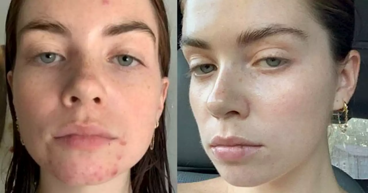 7 Skin Myths Debunked By NYC's 'Acne Whisperer'