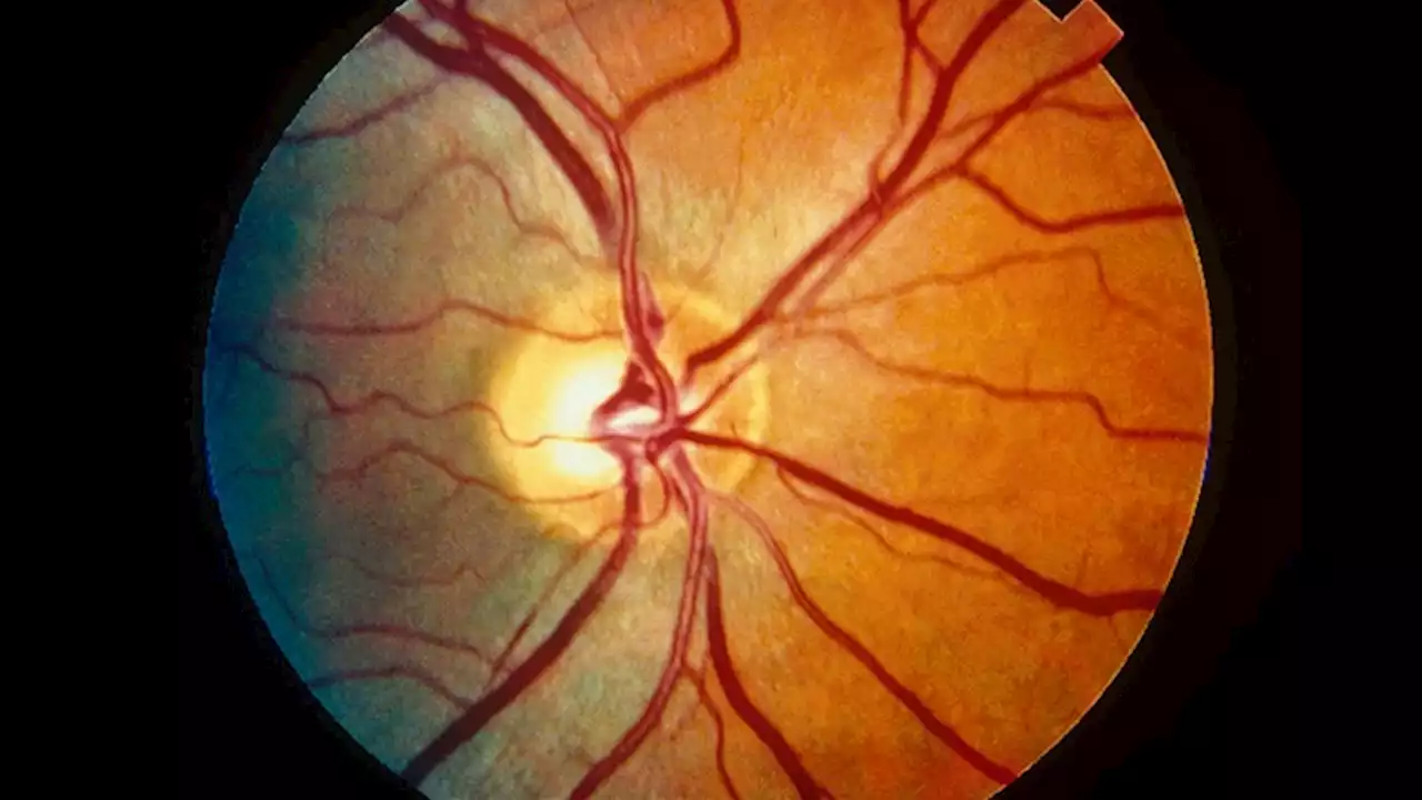 Fast Five Quiz: Management of Inherited Retinal Diseases