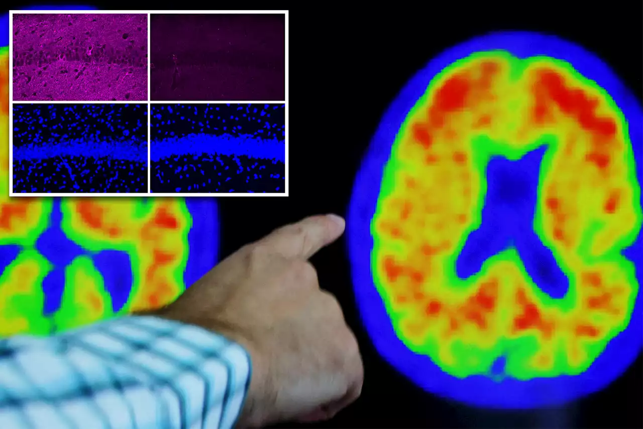 MIT scientists discover ‘remarkable’ way to reverse Alzheimer’s disease