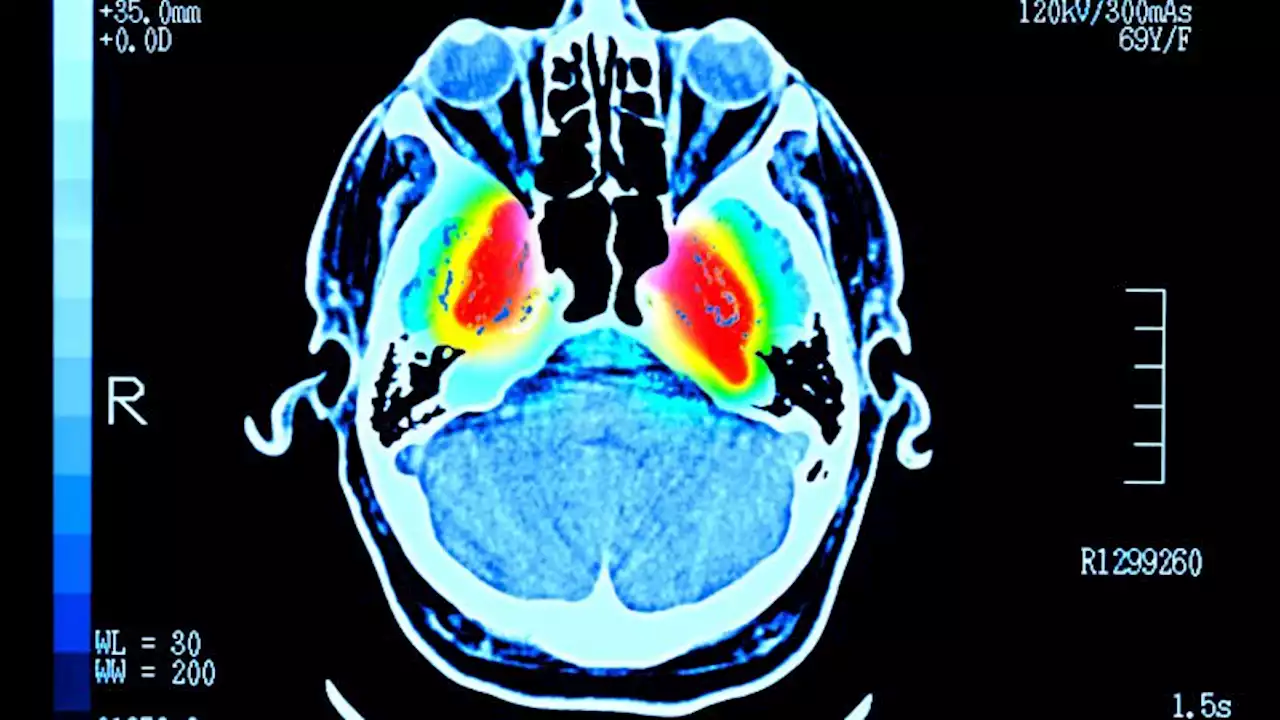 'Big step forward': New lab tests may accelerate Parkinson's diagnosis and research | CNN