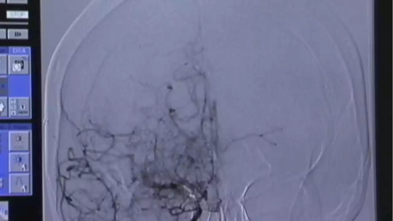 Hope after stroke: New screening method could predict recovery