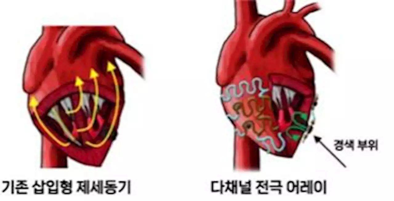 '삽입형 제세동기 대체기술 개발…통증없이 부정맥 진단·치료' | 연합뉴스