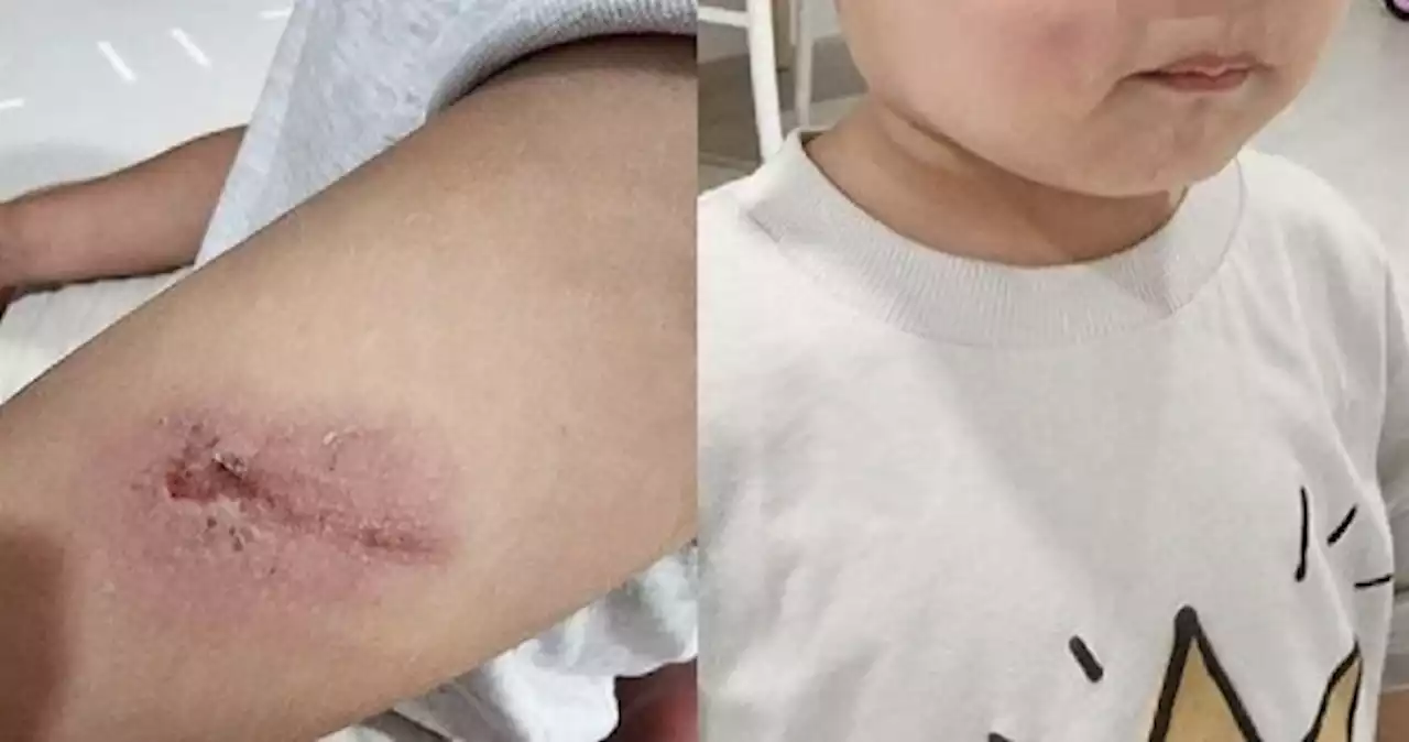 Mum shocked after son returns home from pre-school with bruised face and gash on arm