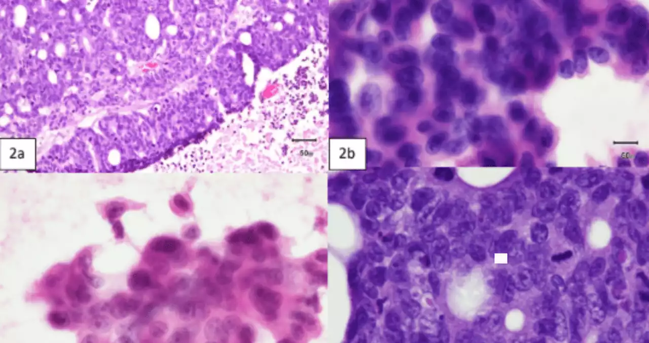 Reportan extraño caso de adenocarcinoma de colon metastásico al cerebro en un hombre de 77 años