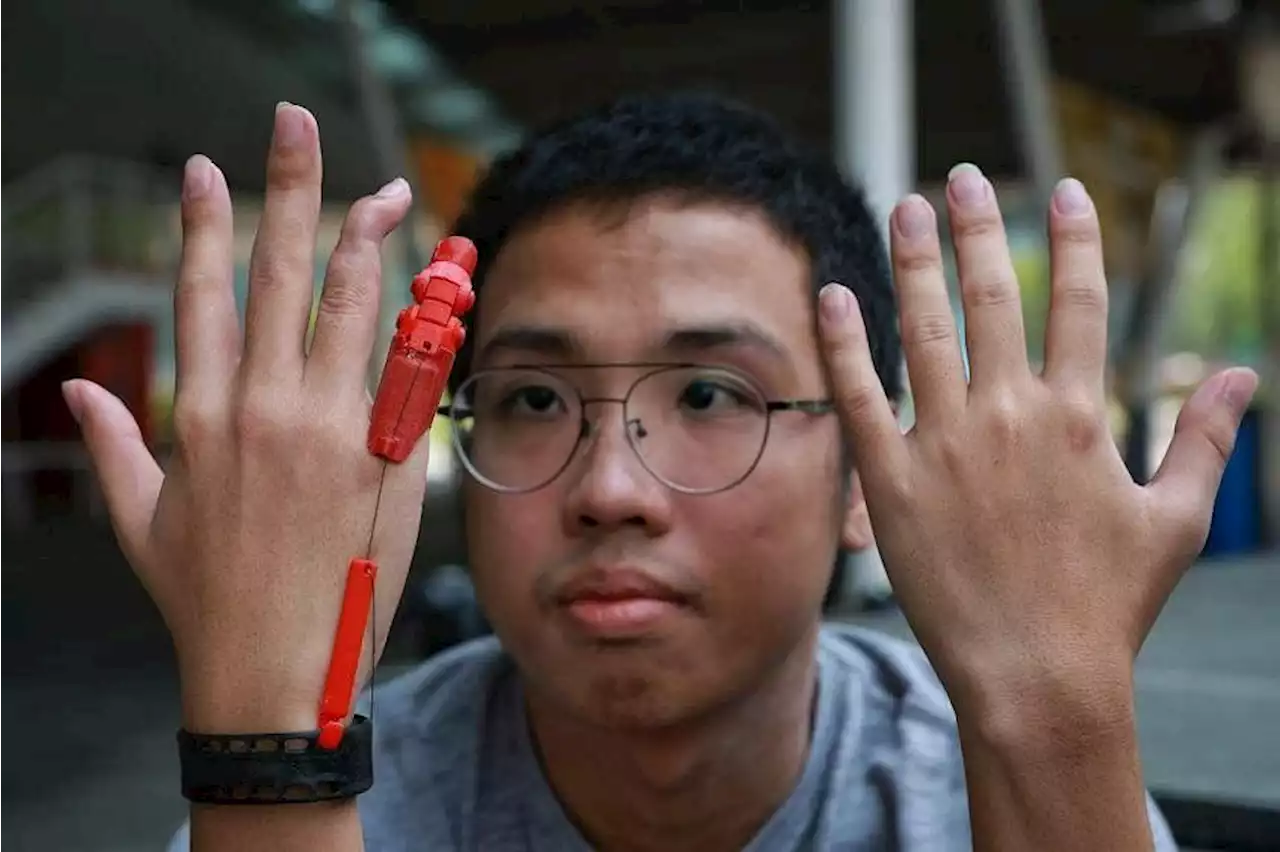 Engineering student gets 3D-printed finger after bike accident