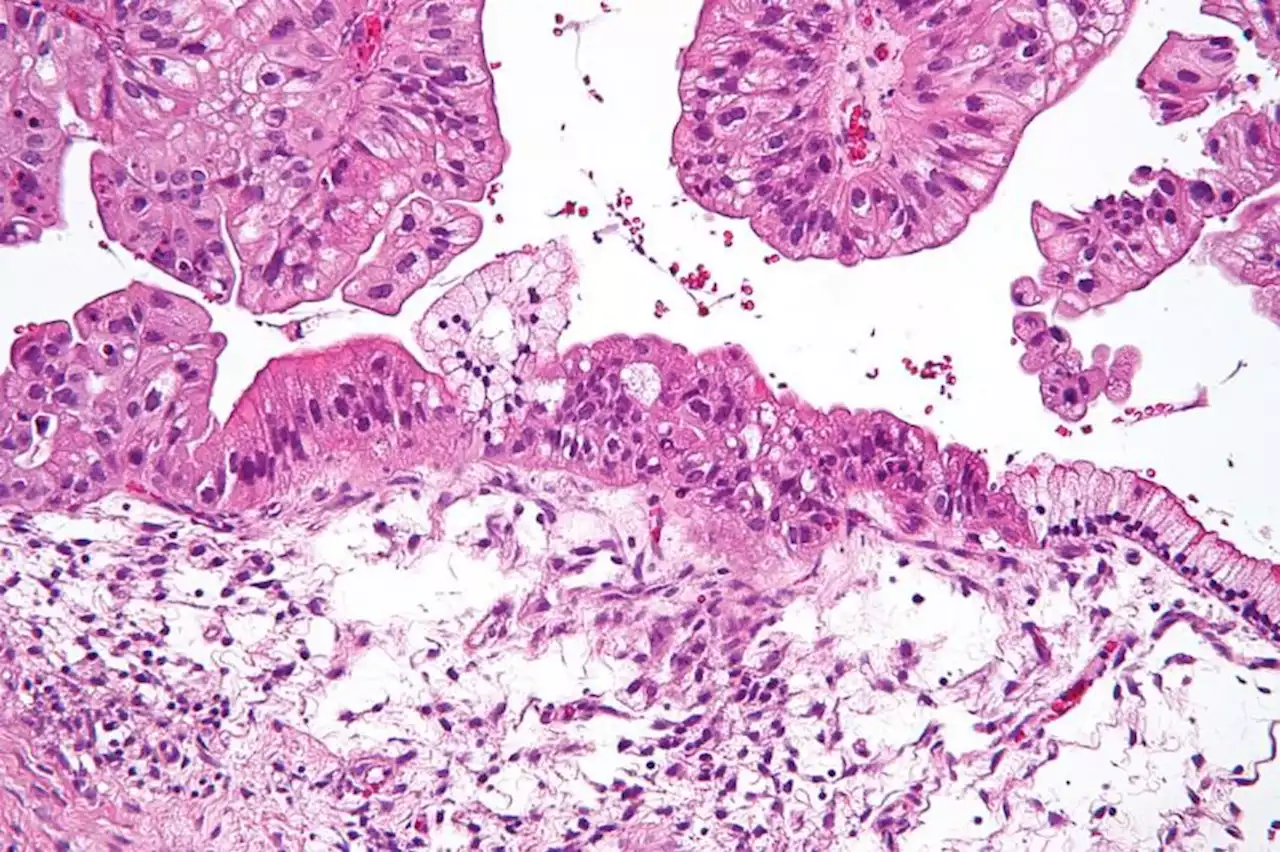 Preclinical study identifies new target for recurrent ovarian cancer