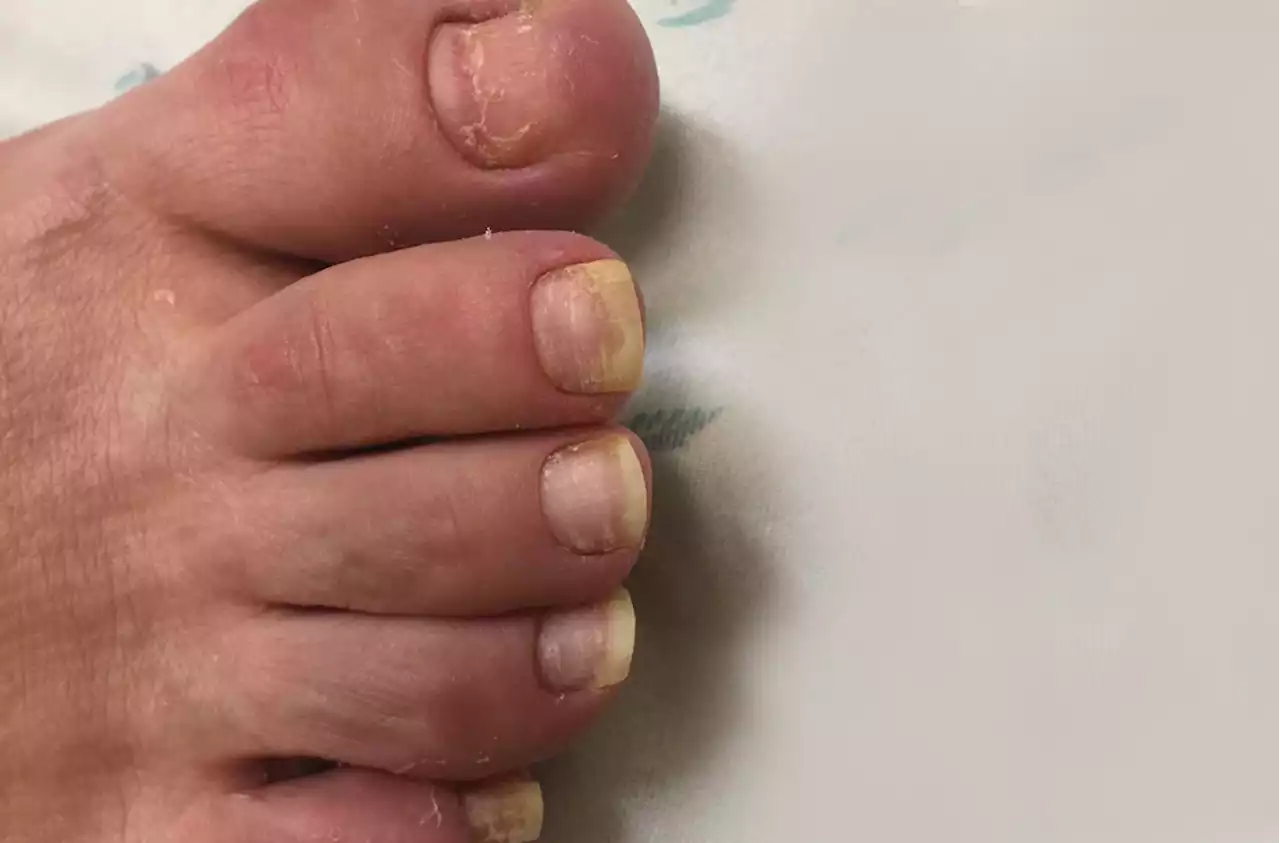 75-year-old man • recent history of hand-foot-mouth disease • discolored fingernails and toenails lifting from the proximal end • Dx?