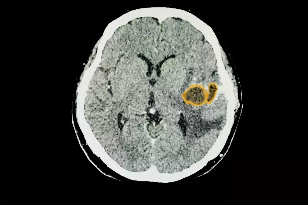 Glioma pontino intrínseco: desarrollan una nueva terapia potencial para tratar este letal tumor cerebral