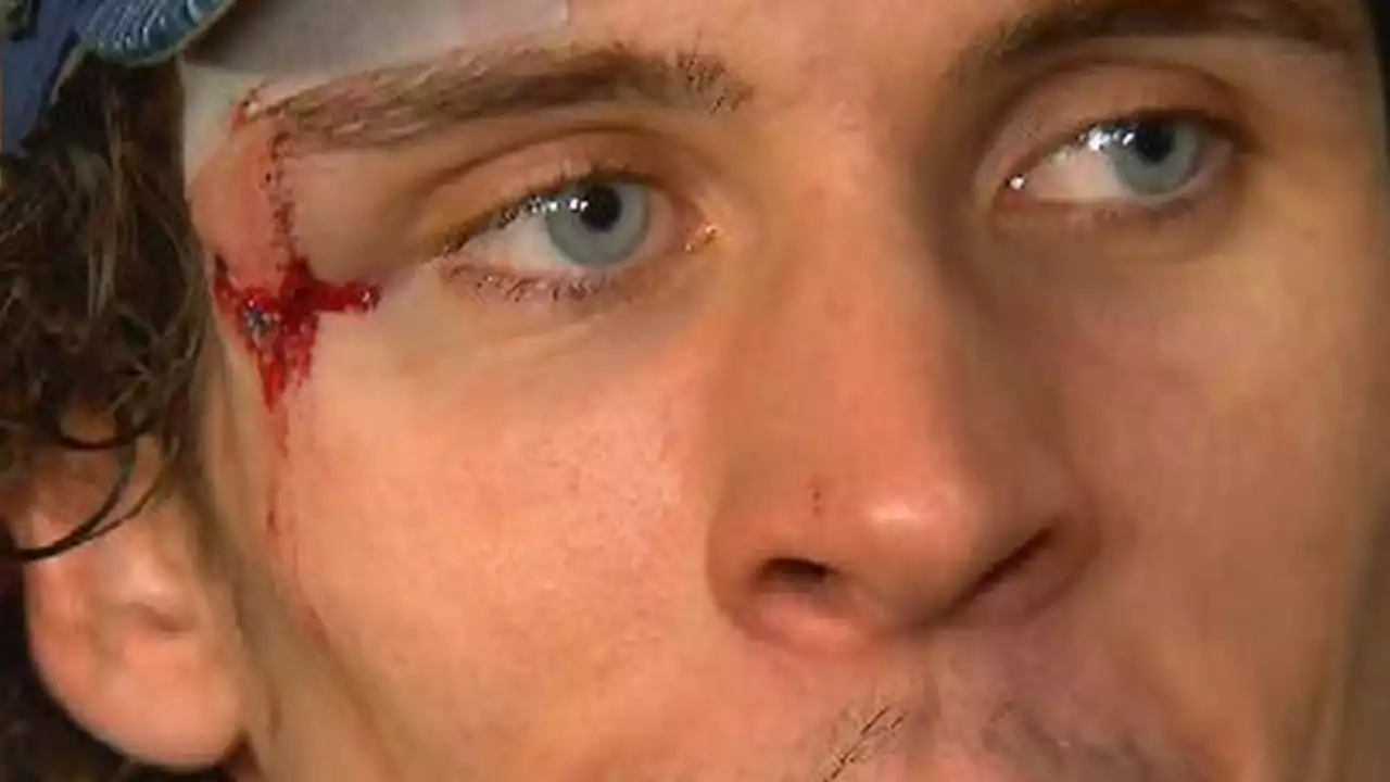 NHL's Morgan Barron Gets 75+ Stitches After Taking Skate To Face, Returns To Game