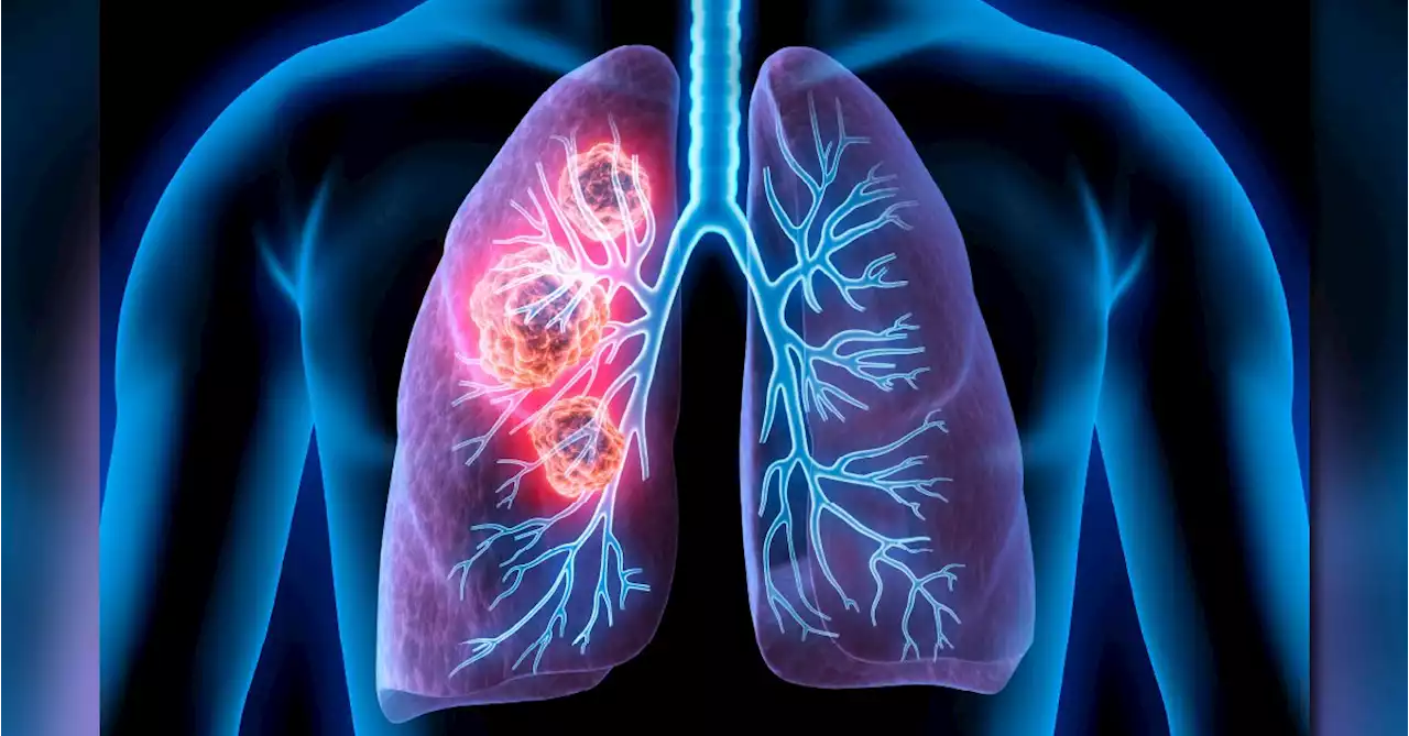 A Visual Guide to Lung Cancer