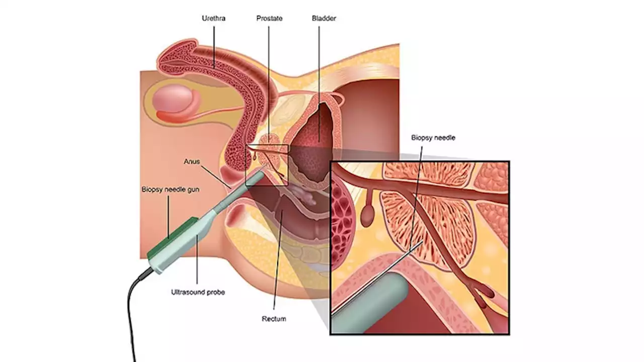 Death Spurs Country's Shift to Safer Prostate Biopsies