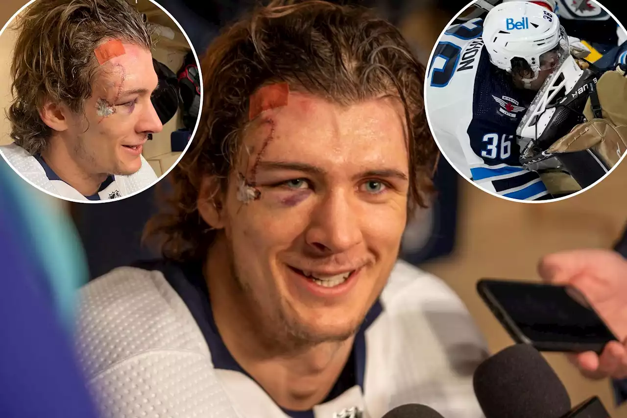 Jets’ Morgan Barron shows off gnarly scars from 75 stitches after taking skate to face