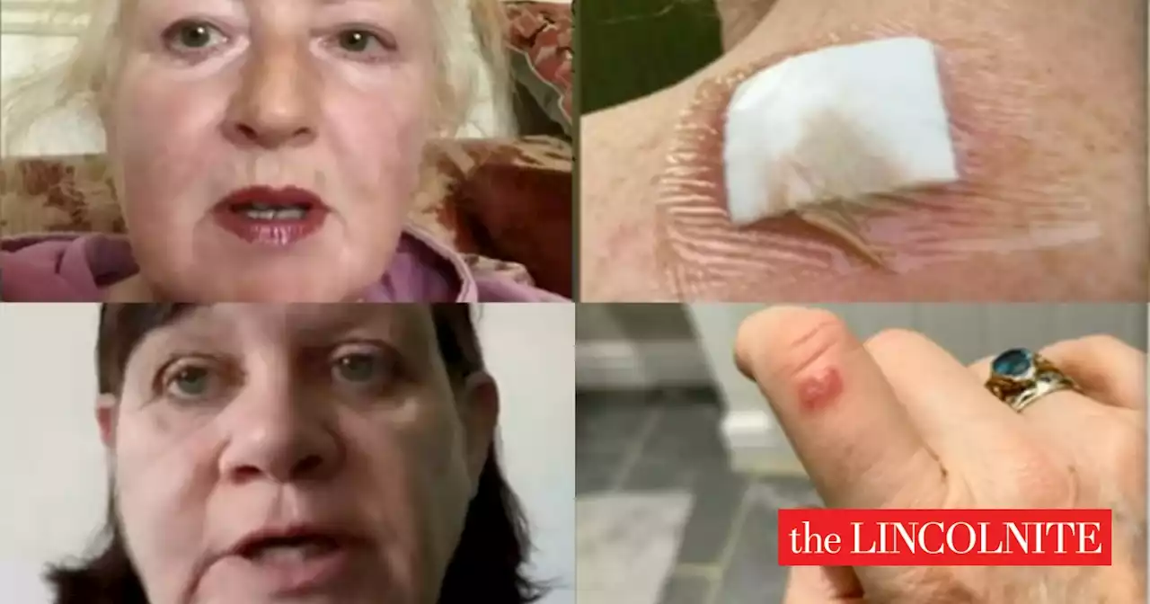 Ouch! More Lincolnshire people's spider bite stories