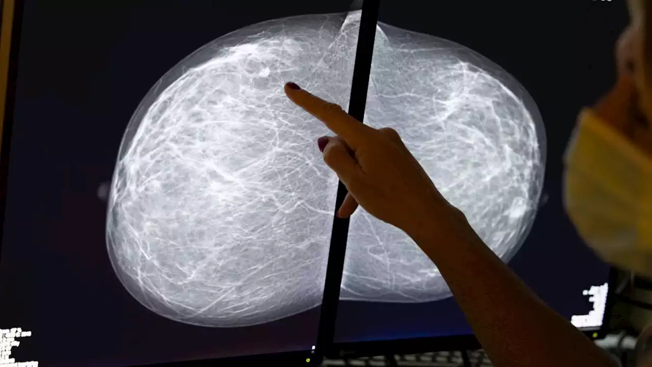 Black patients may need breast cancer screenings earlier than what many guidelines recommend