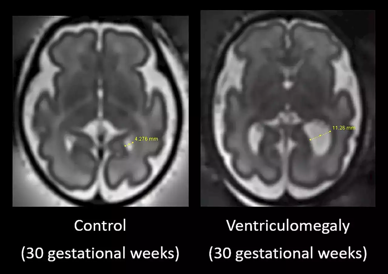 Peering Into the Womb: Fetal Brain Scans Reveal Autism Clues