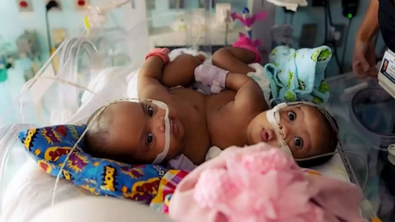 Formerly conjoined twins celebrated with baby shower