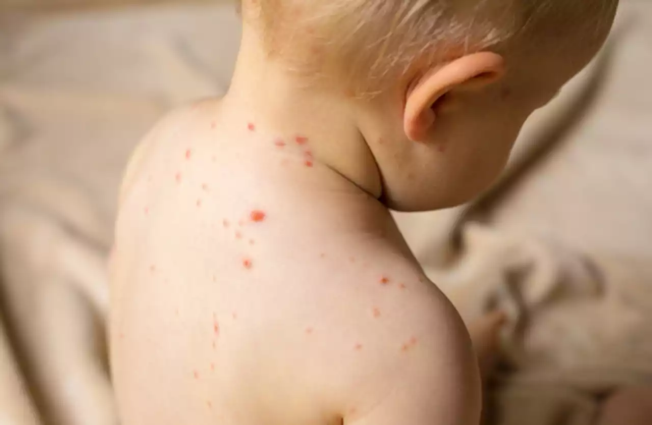 Ireland has one of the lowest rates of measles immunisation in Europe