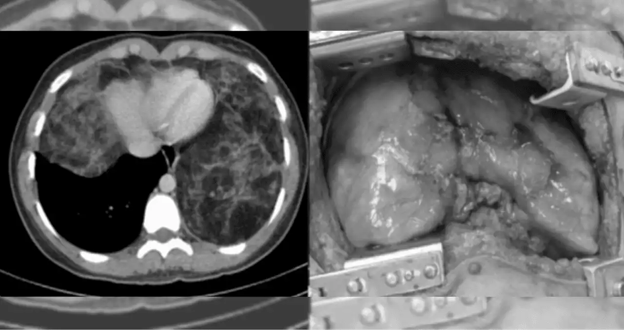 Hallan timolipoma gigante, un tumor benigno poco común en una mujer joven de 21 años