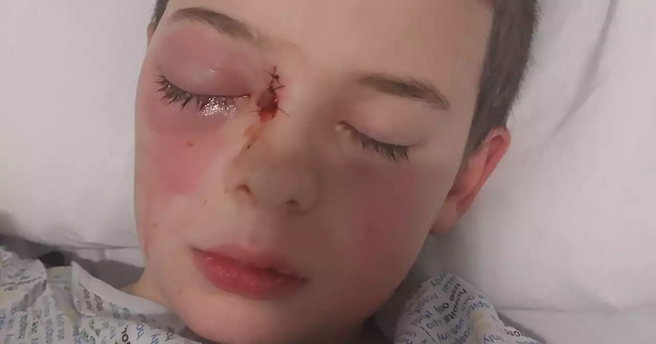 Scots schoolboy ‘hours away from losing eye’ after Strep A caused huge infection