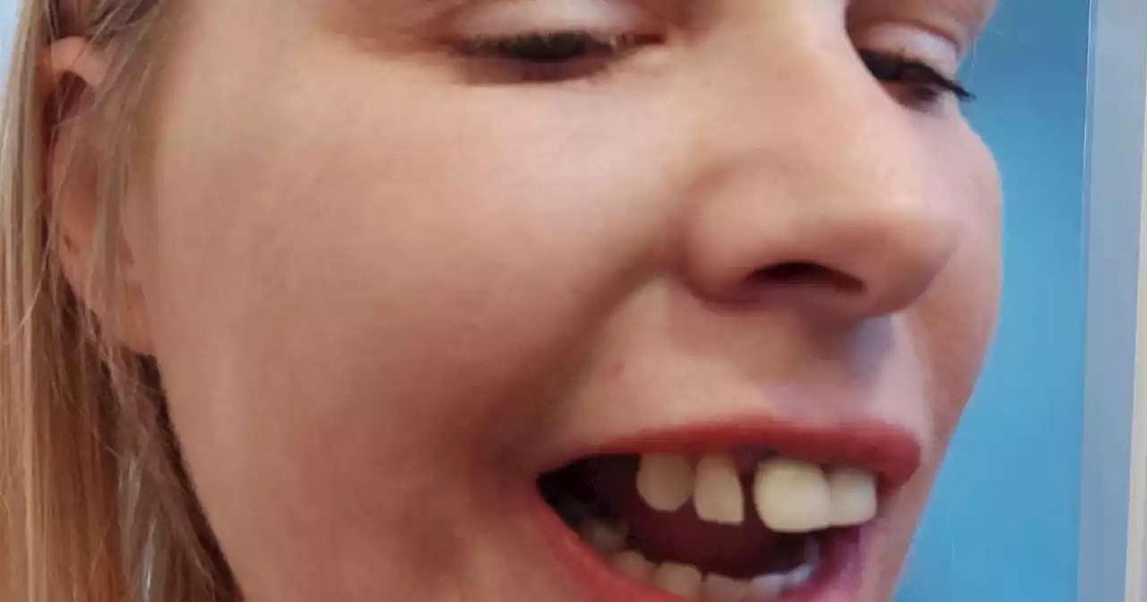 Mum afraid to smile after ex knocked out teeth now dating thanks to Turkey Teeth