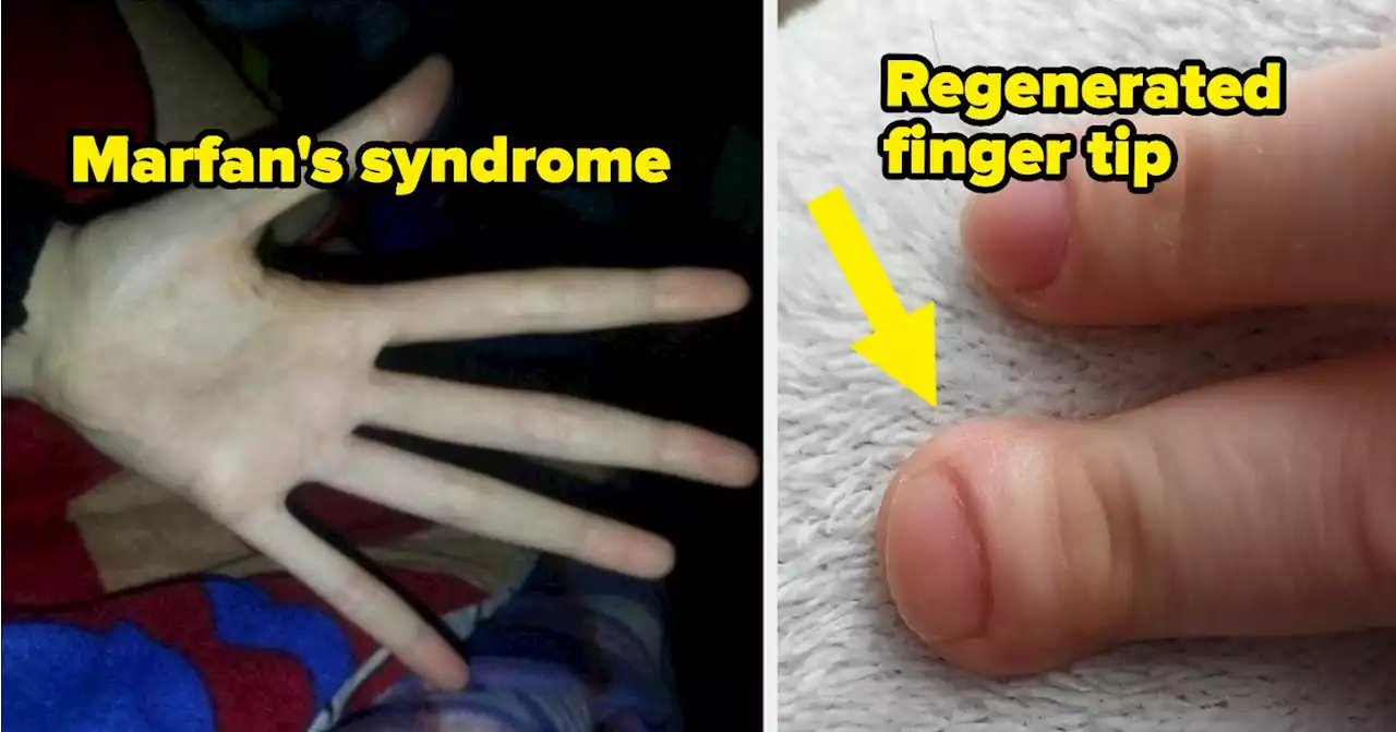 17 People Who Proudly Shared Their Fascinating Body Abnormalities