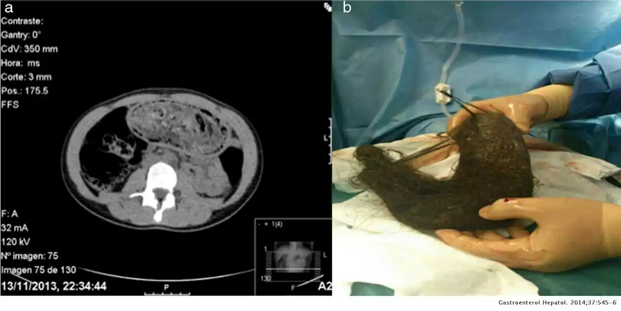 Bebé de dos años, con antecedentes de anemia, presenta rara bola de pelo en tracto gastrointestinal