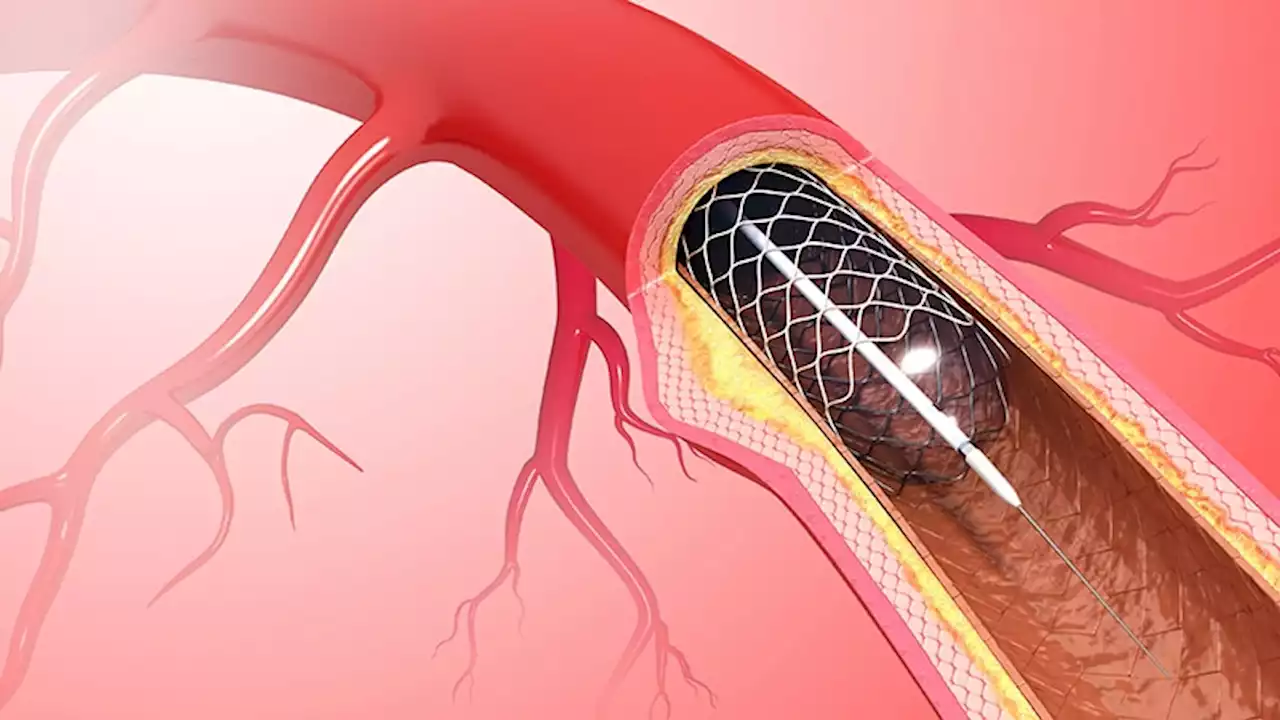 High Biomarker Level Plus Diabetes Predict Bad PCI Outcomes