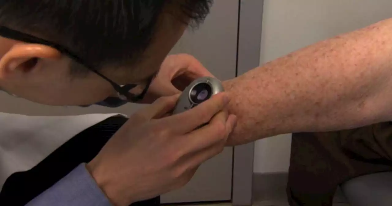 Skin Cancer Awareness Month: Why survival rates for melanoma are increasing