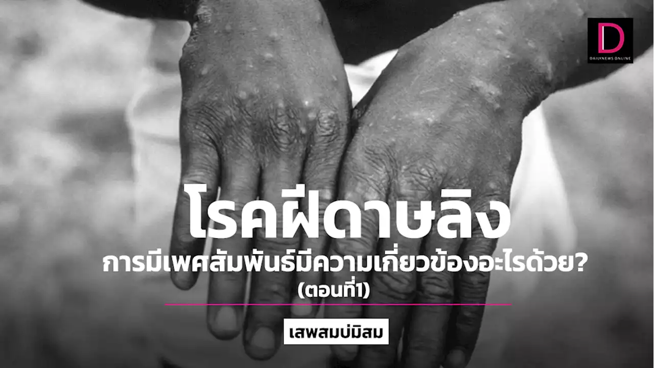 โรคฝีดาษลิง : การมีเพศสัมพันธ์มีความเกี่ยวข้องอะไรด้วย? (1) | เดลินิวส์