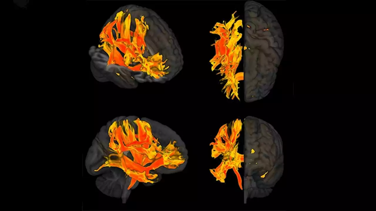 Specific Brain Damage Links Hypertension to Cognitive Impairment