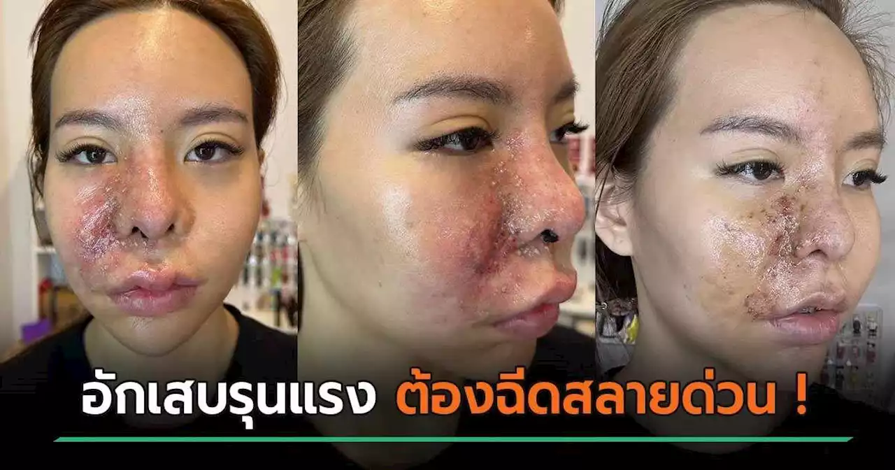 น้องมะลิ เผยสาเหตุหน้าบวม กับอุทาหรณ์เตือนสายฉีด... หวิดดับ-เกือบตาบอด !