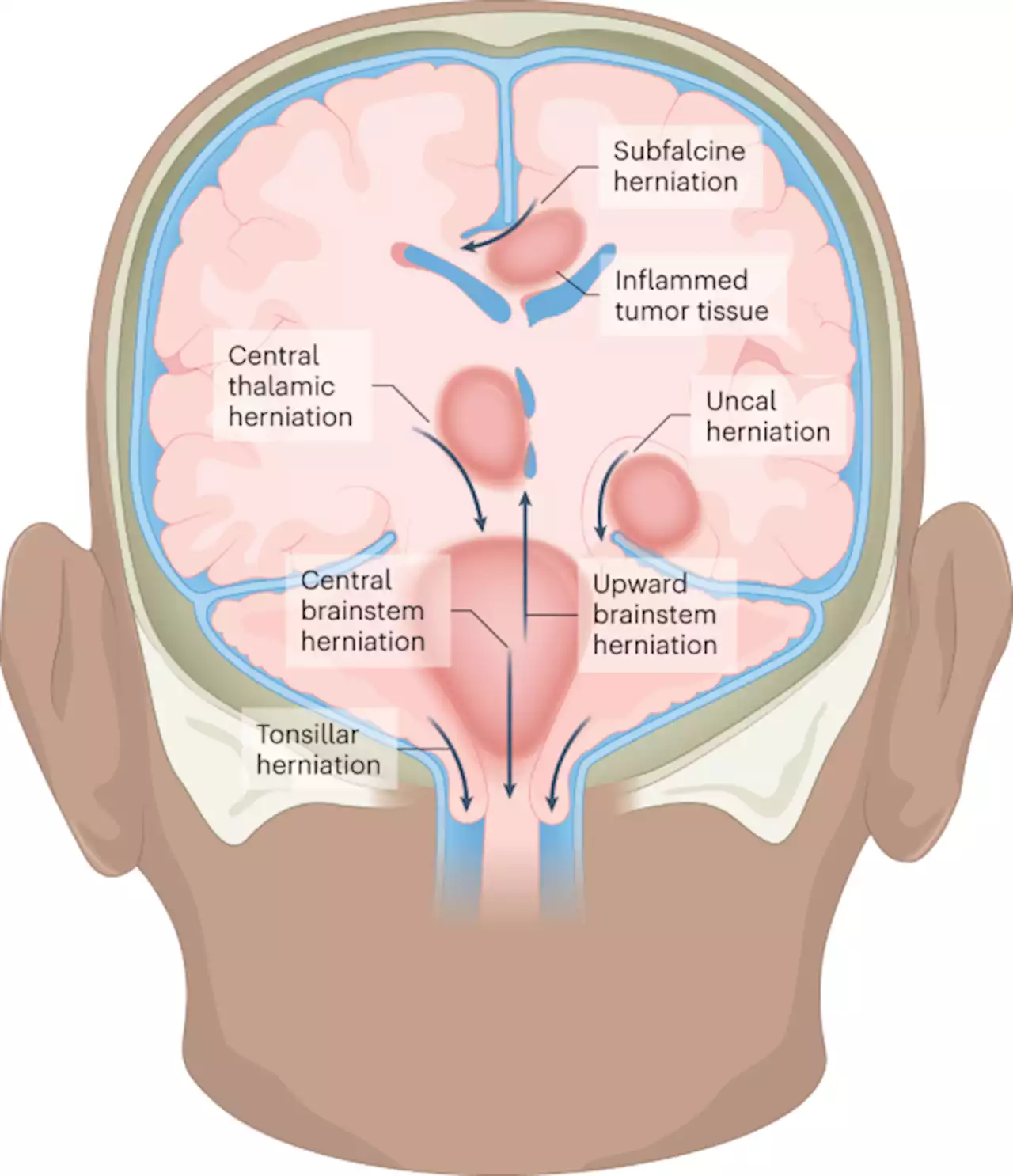 Tumor inflammation-associated neurotoxicity - Nature Medicine