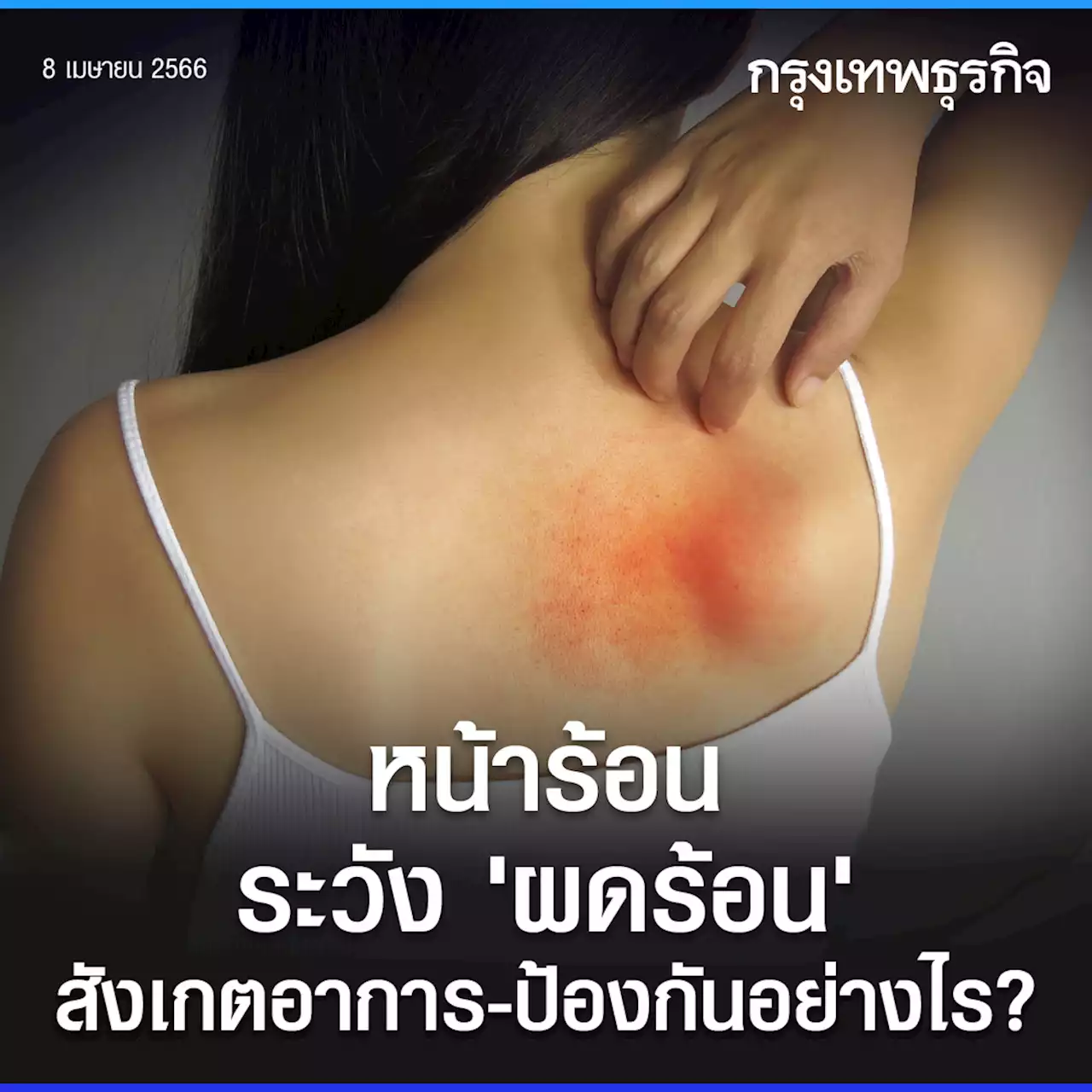 หน้าร้อนต้องรู้ 'ผดร้อน' สังเกตอาการ รักษา ป้องกันอย่างไร