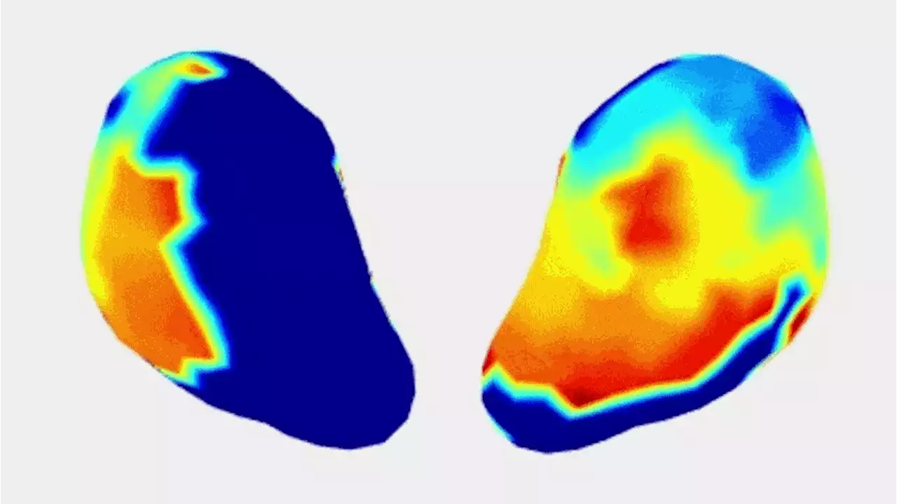 Electromyometrial Imaging: Mapping Uterine Contractions To Improve Labor Management