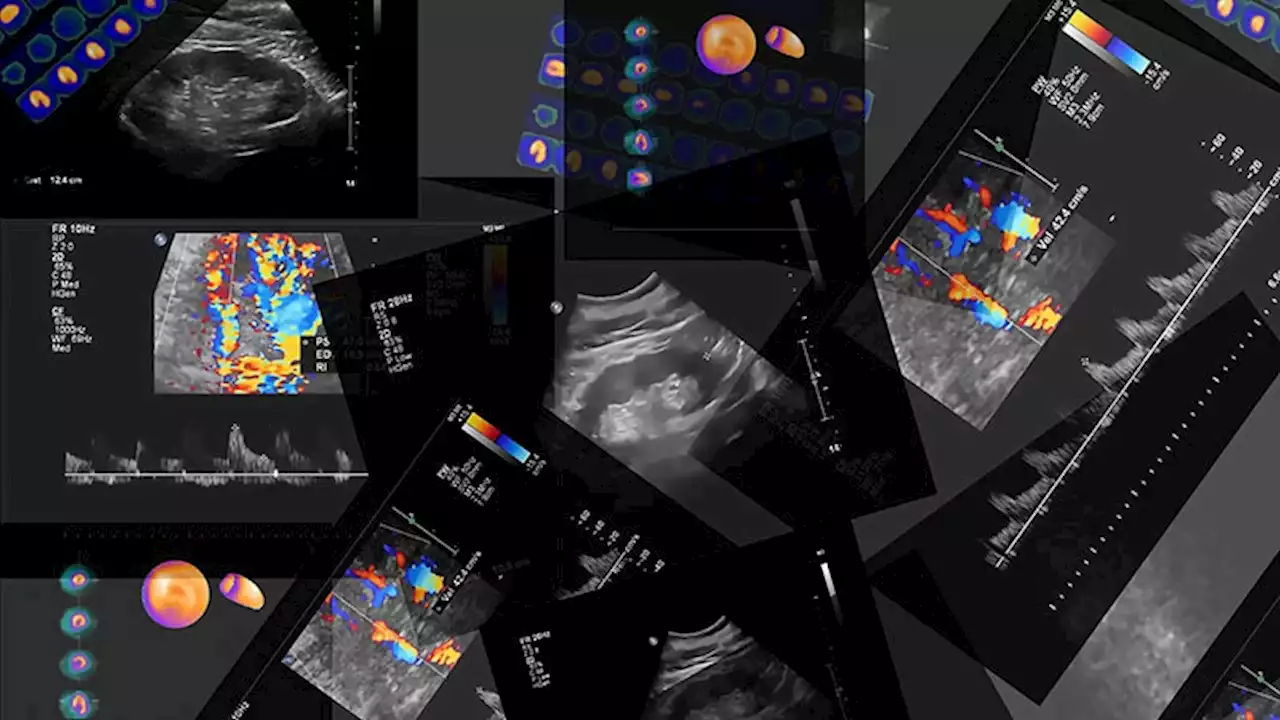 Stroke Scale Cutoff Might Not Be Ideal Guide