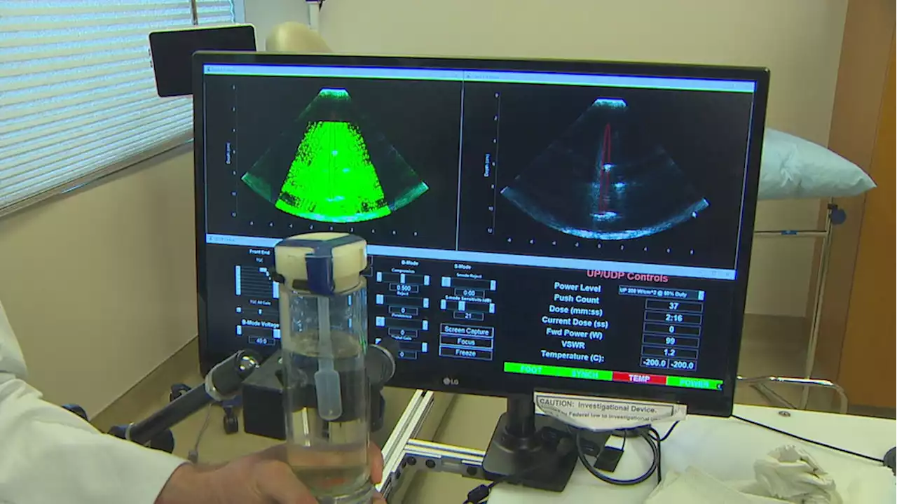 Breakthrough kidney stone procedure called 'game changer' for patients