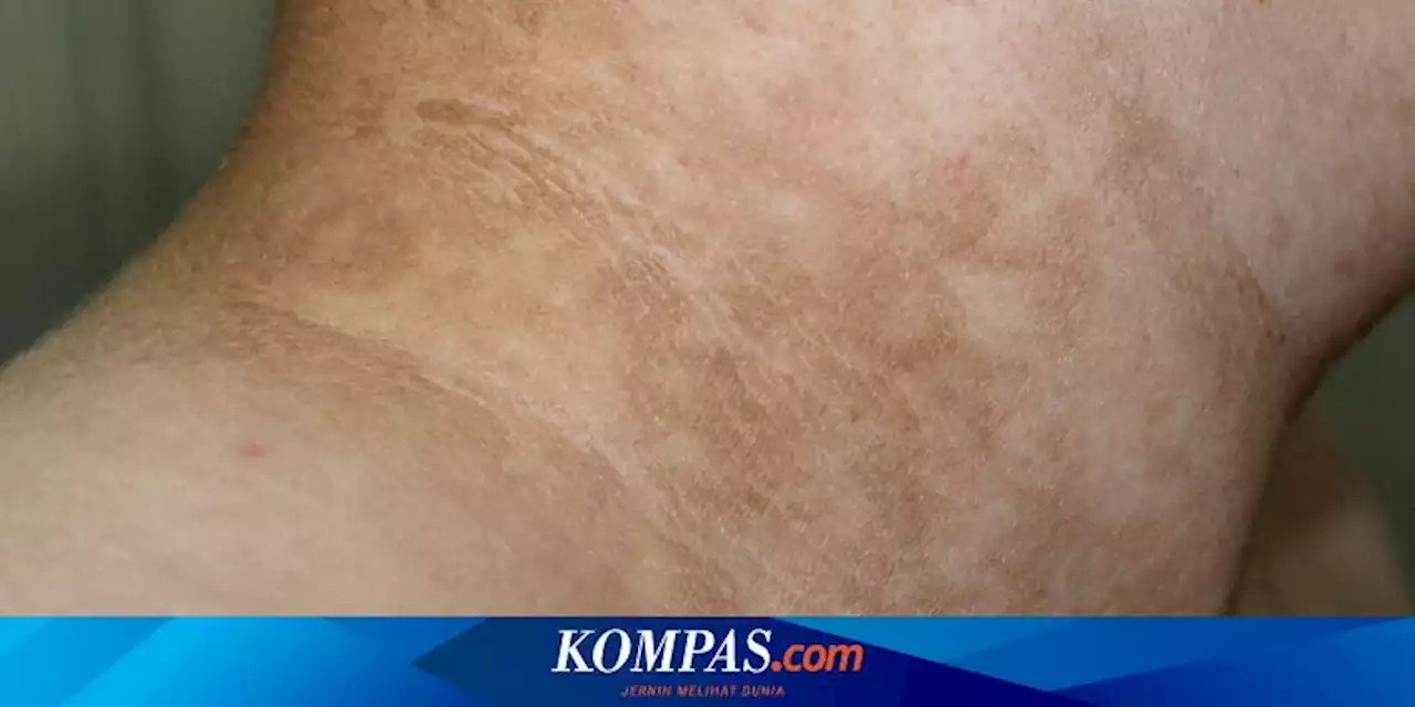 Bukan Malas Mandi, Area Gelap di Kulit Bisa Jadi Tanda Diabetes