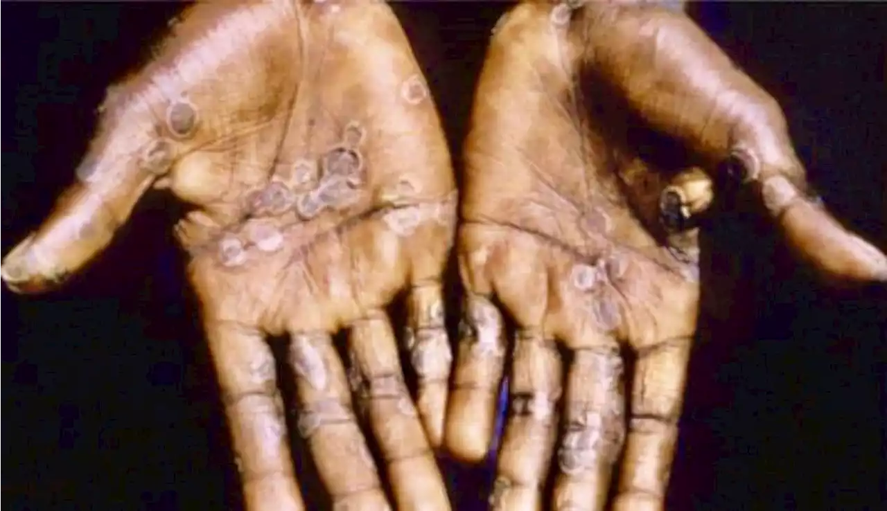 DOH reminds public to stay alert amid lifting of public health emergency on monkeypox