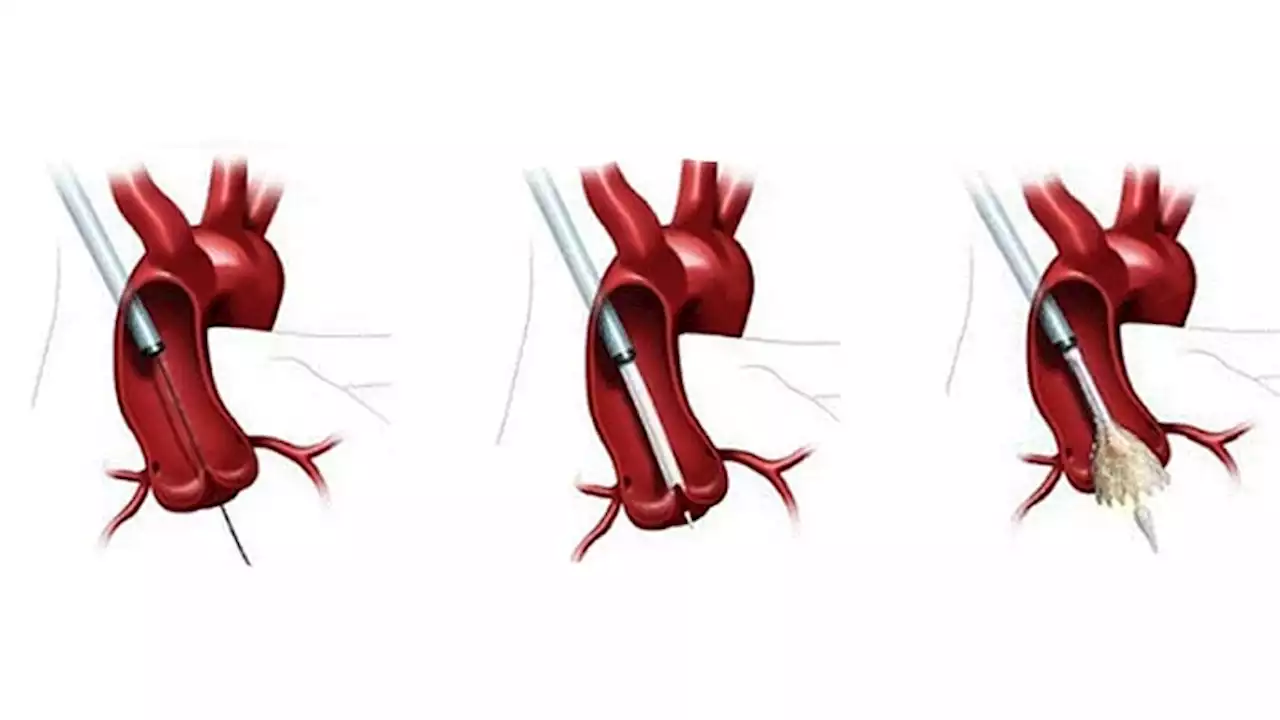 Better Access to TAVR Associated With Improved Outcomes