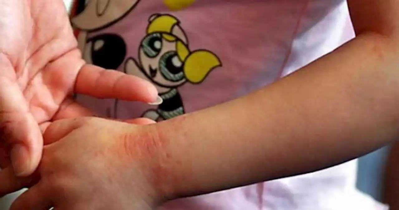 Baby eczema: What you need to know about tending to your child's sensitive skin