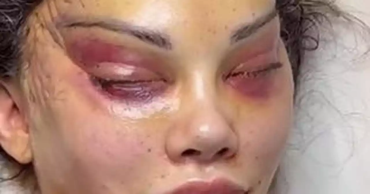 Influencer left with 'deformed' face after undergoing invasive 'cat eye' surgery