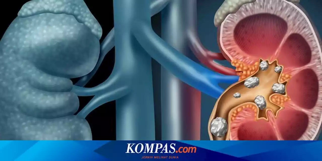 4 Komplikasi Batu Ginjal yang Harus Diwasadai