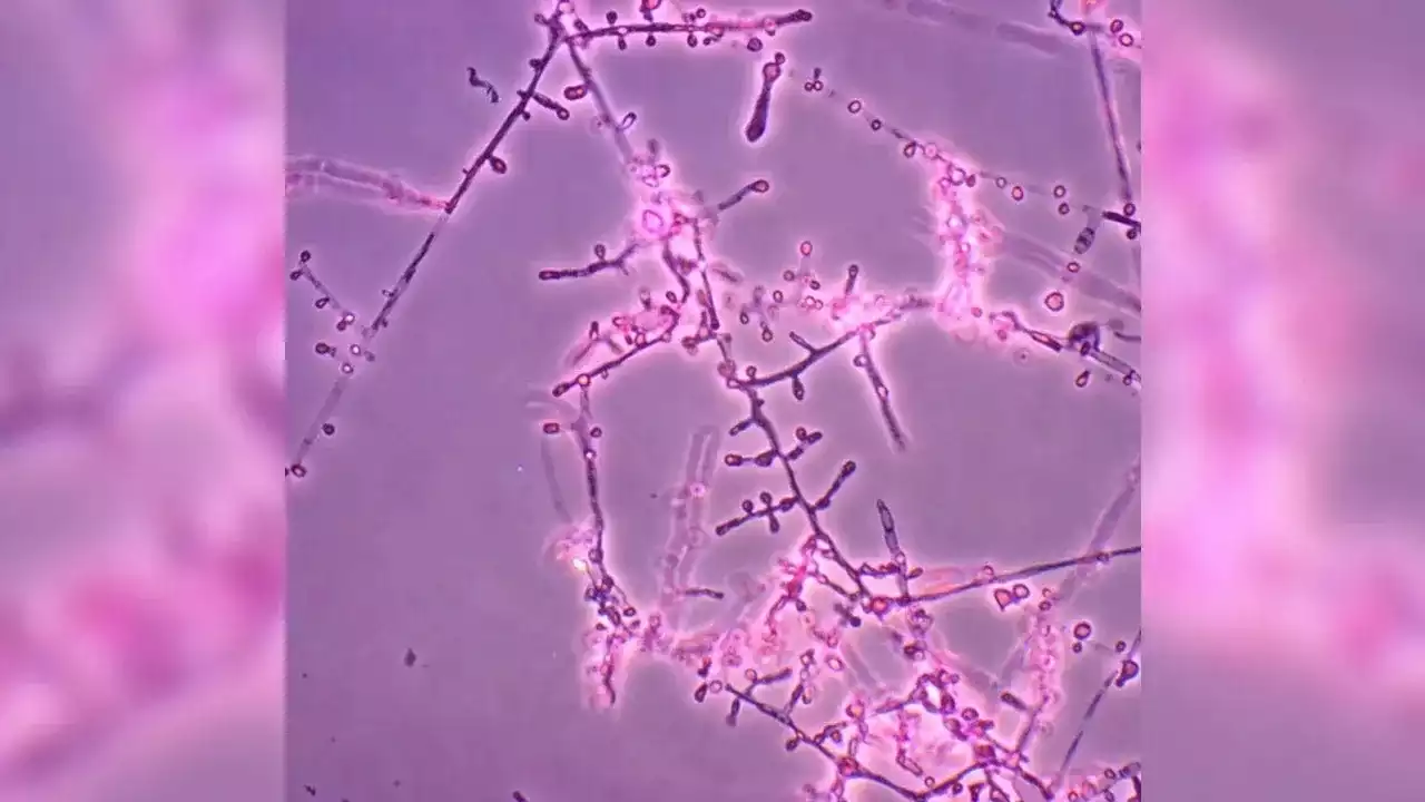 Primeiros casos de micose resistente ao tratamento são relatados nos EUA