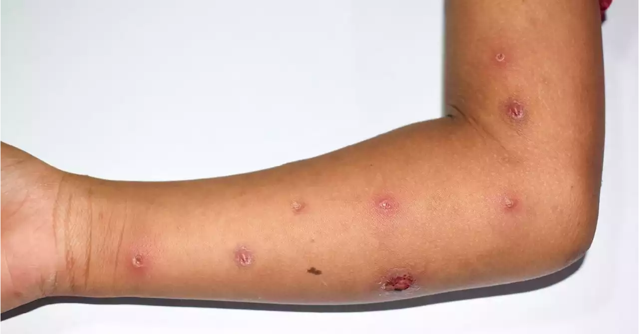 CDC Warns of Mpox Resurgence This Summer