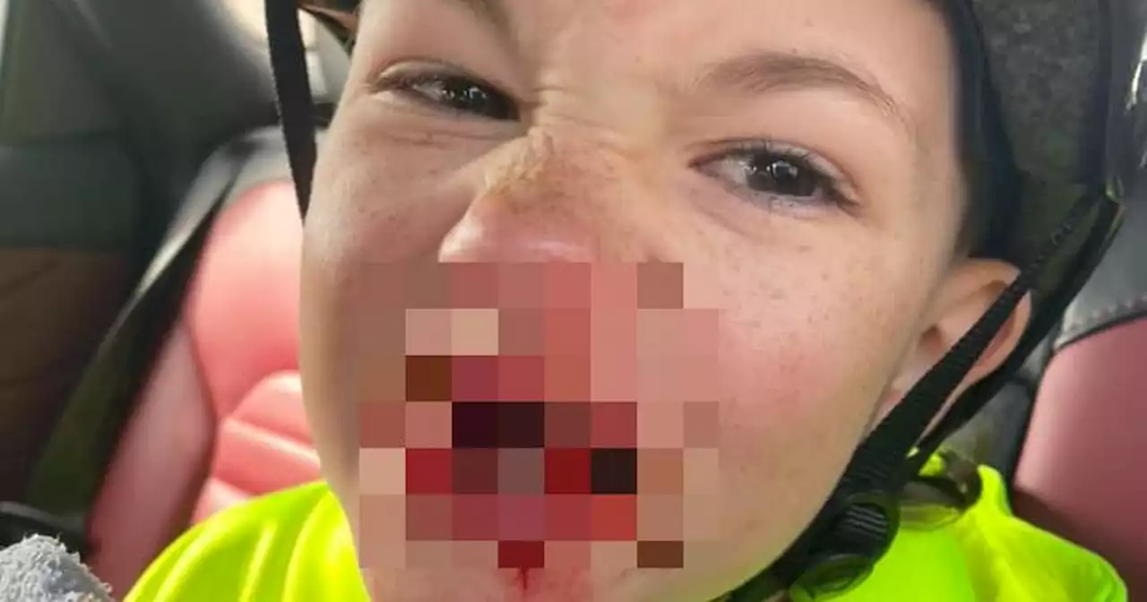 Mum of boy with horror BMX injury says helmet saved life