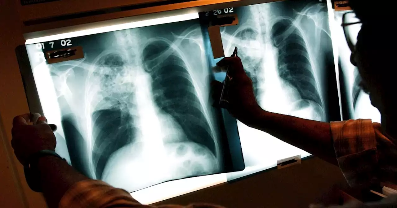 Why tuberculosis cases have risen in recent years after decades of decline