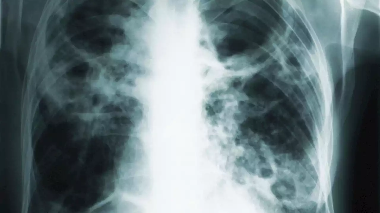 Judge gives 17th order for woman with tuberculosis to self-isolate or get treatment