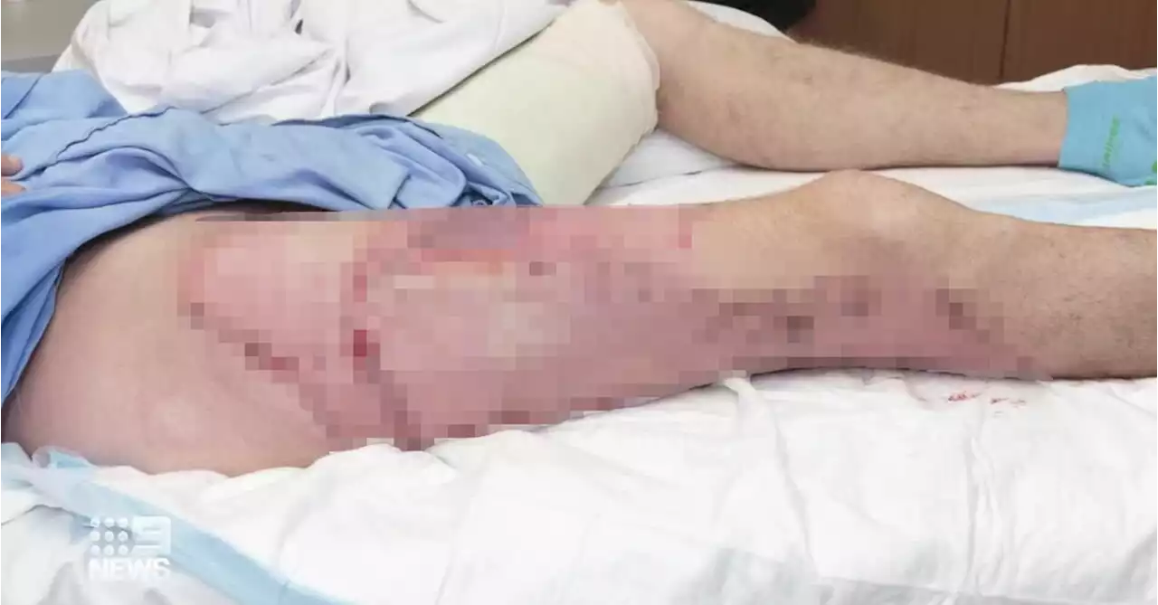 Perth man left with third-degree burns after vape 'exploded' in his pocket