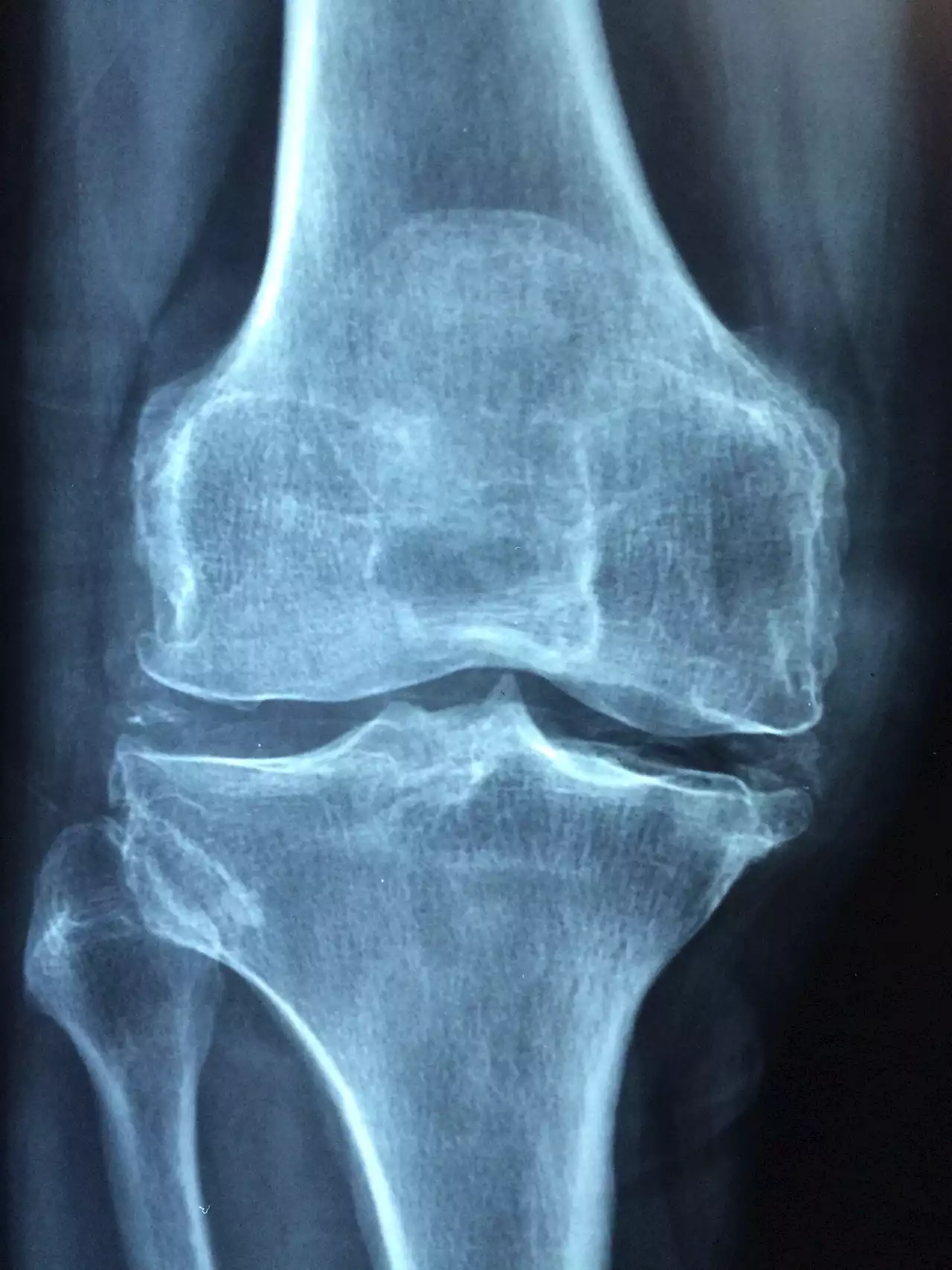 Commonly used tool found to be suboptimal in predicting osteoporosis fracture risk in younger post-menopausal women