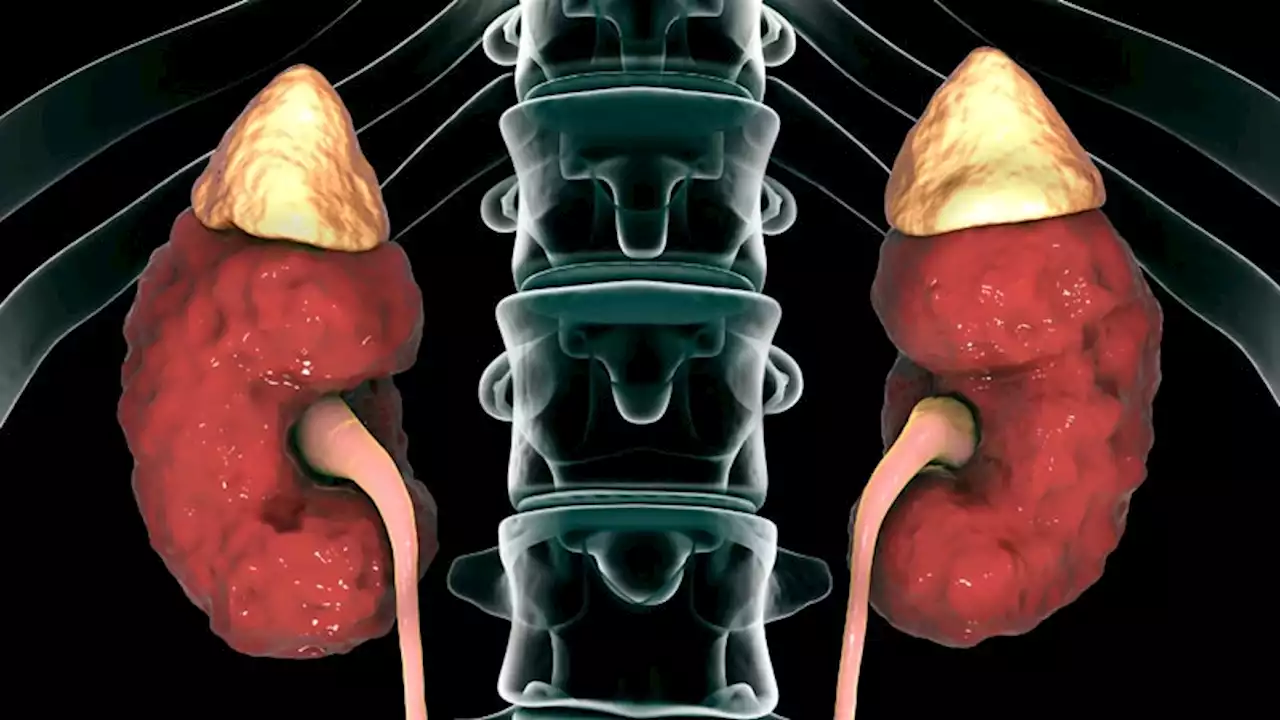 Fast Five Quiz: Chronic Kidney Disease Signs and Symptoms